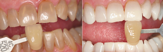 Before_After_0719_Mouth
